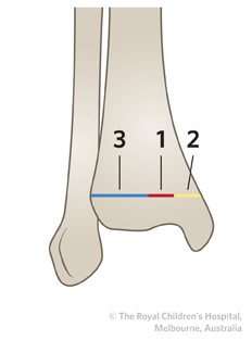 Figure 1 TIBIAL PHYSIS CLOSURE Figure 1 TIBIAL PHYSIS CLOSURE